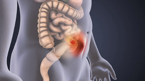 hernia surgery